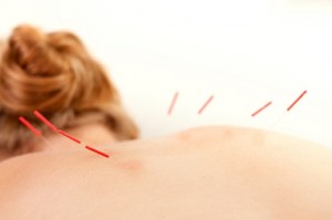 Acupuncture_treatment