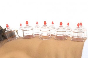 Cupping treatment