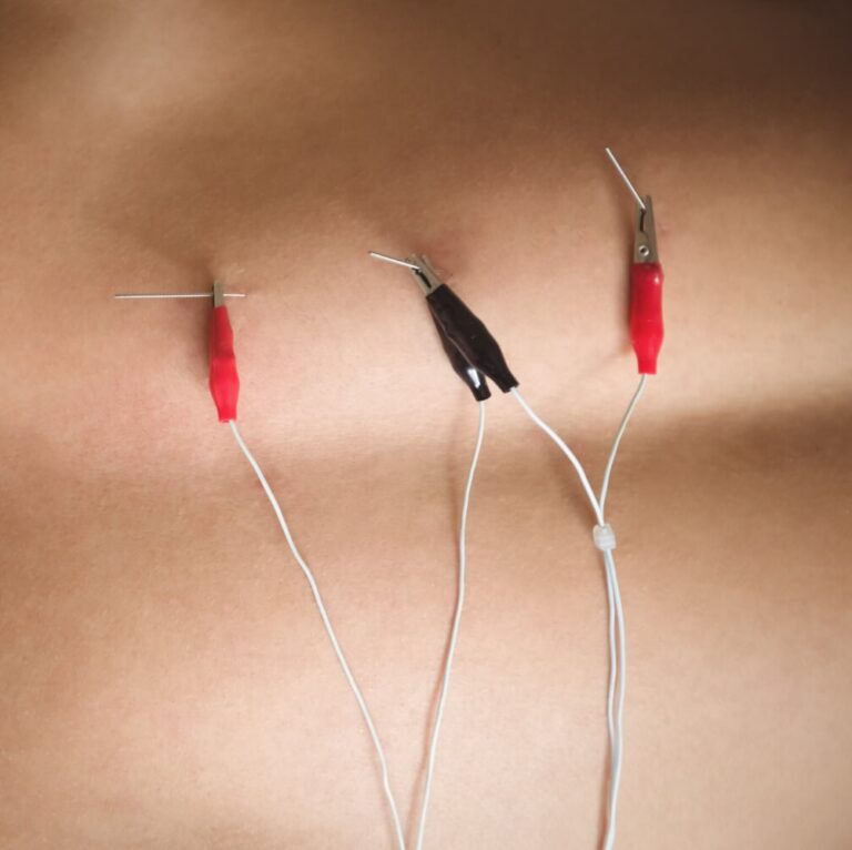 Electro-acupuncture treatment with electrodes placed on the back to stimulate muscle response at Family Acupuncture Clinic Jacksonville.
